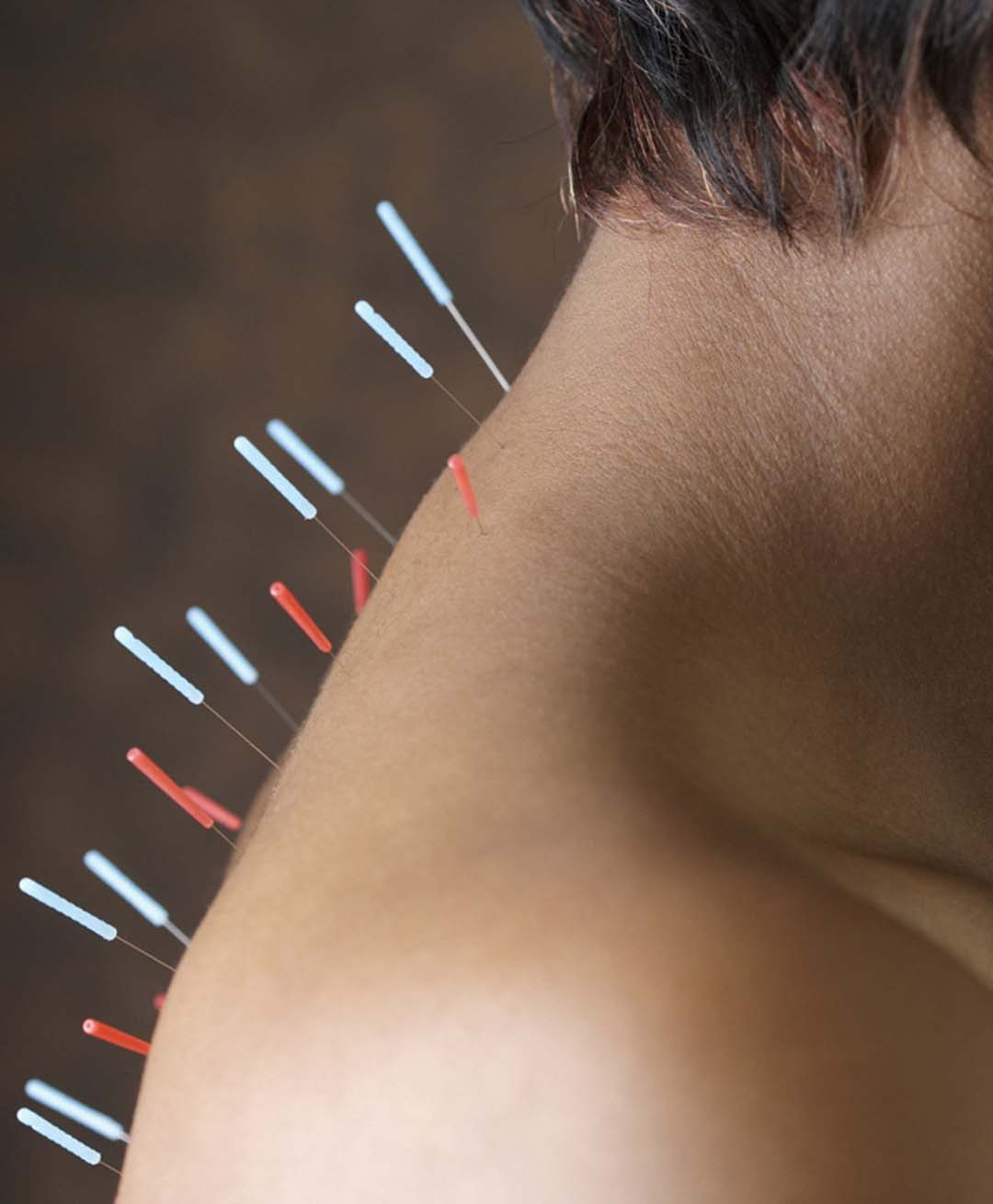 acupuncture near me
