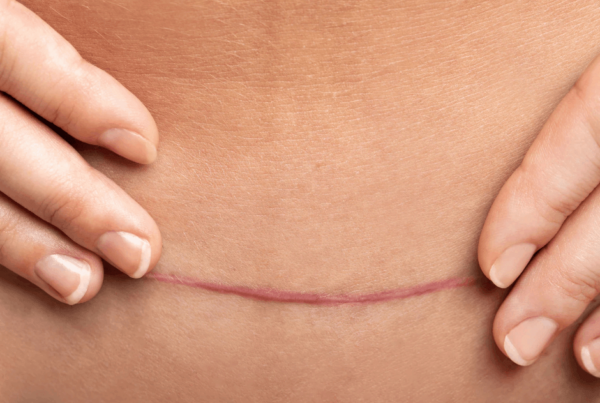Close-up of hands gently touching a healed, pink surgical scar across the abdomen, suggesting recovery and careful self-care.
