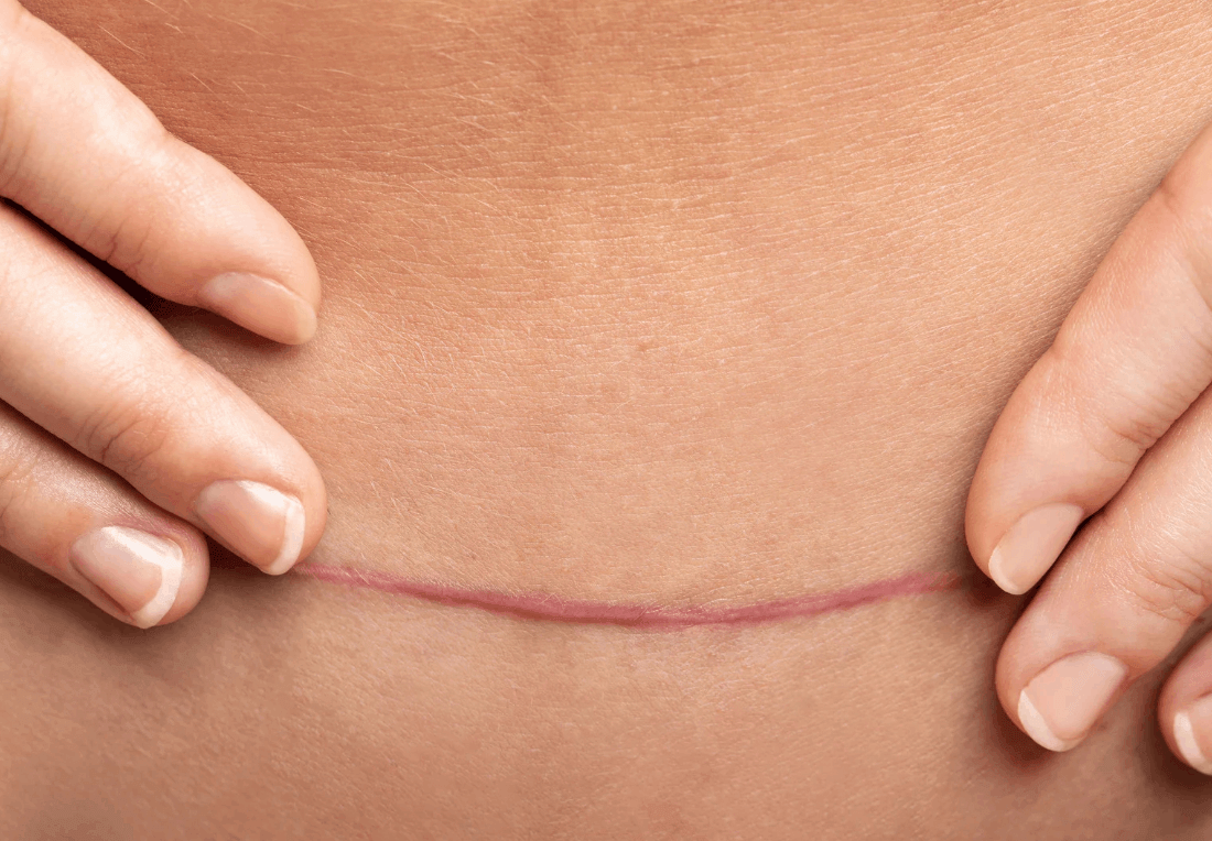 Close-up of hands gently touching a healed, pink surgical scar across the abdomen, suggesting recovery and careful self-care.